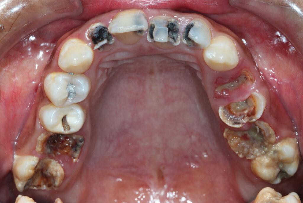 dental abscess , common emergency in carlsbad