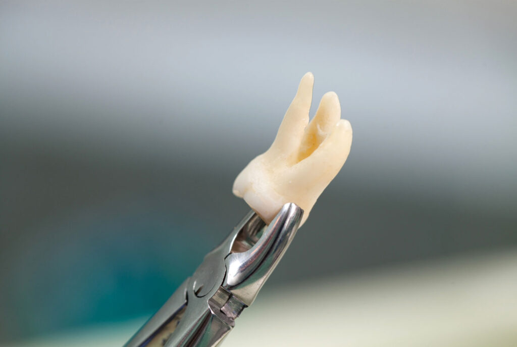 tooth extraction takes 20 to 40 minutes timing