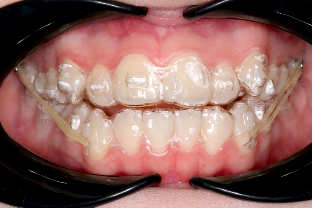 patient wearing Invisalign clear aligners in Carlsbad