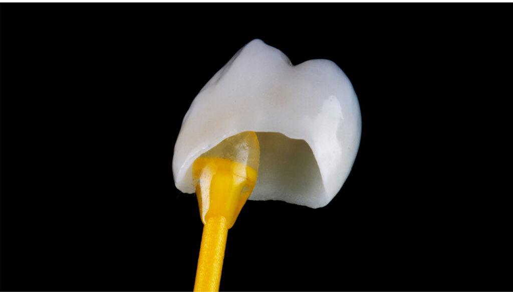 porcelain dental crown on a front tooth