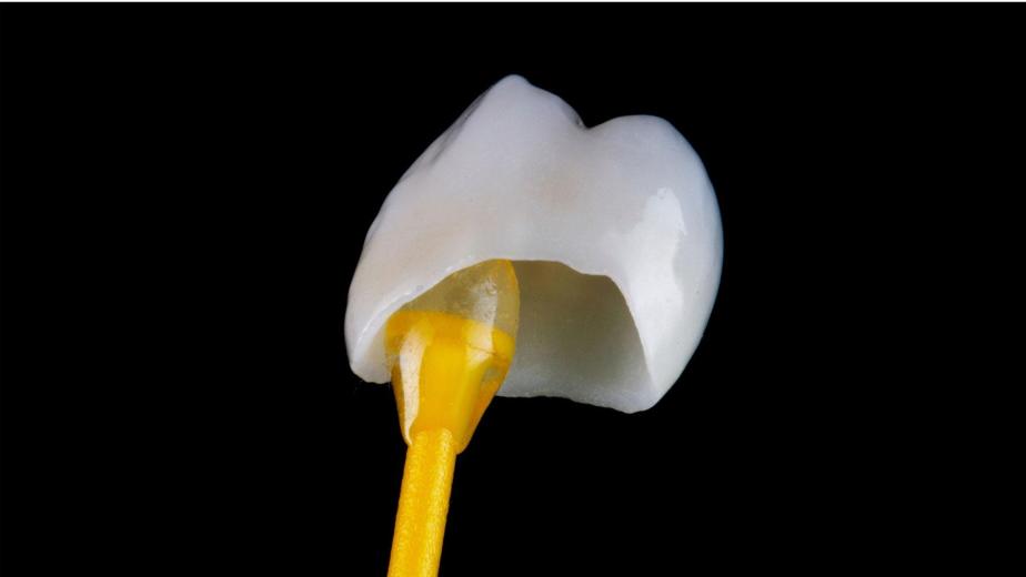 porcelain dental crown on a front tooth