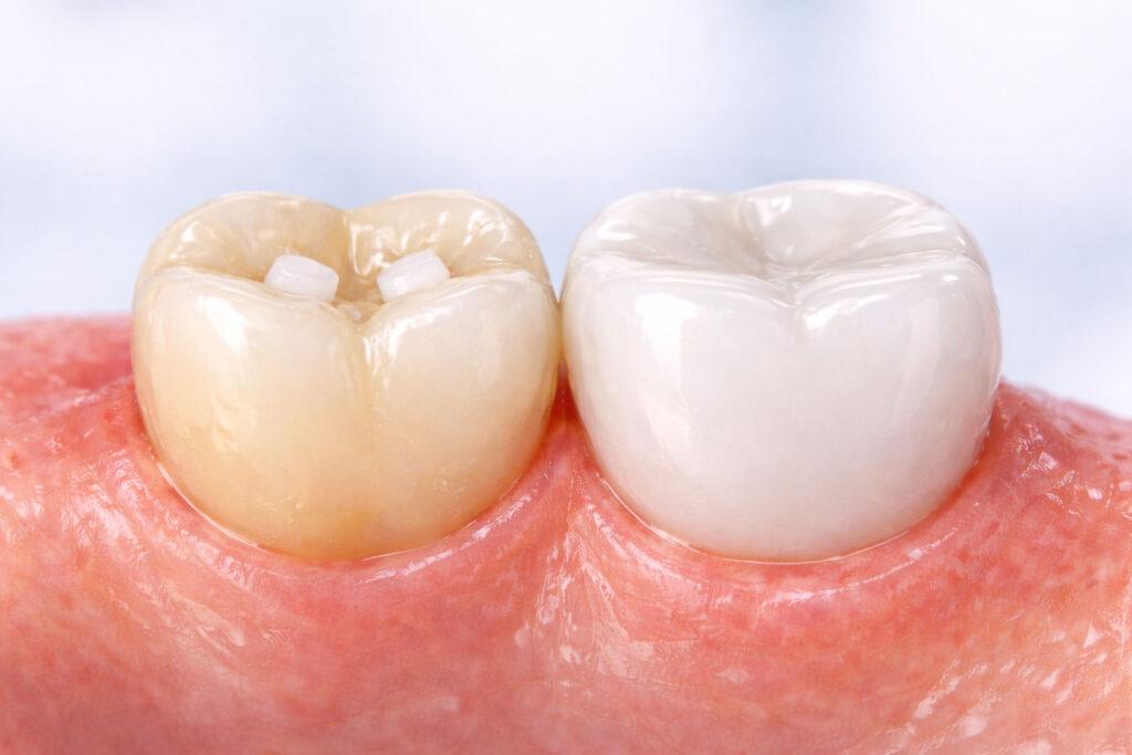 dental crown vs dental filling comparison