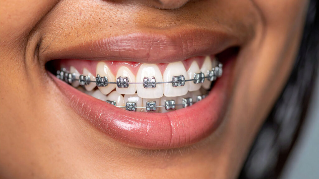 braces consultation in Carlsbad Smiles For Health