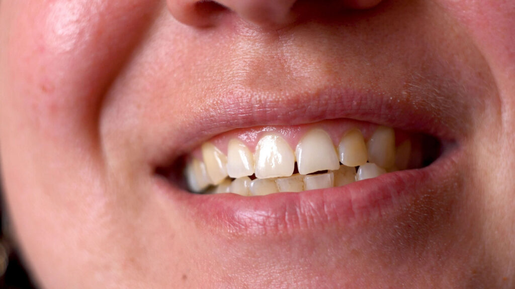 protruding teeth higher injury risk braces