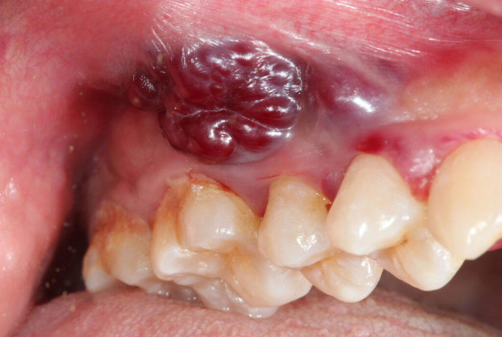 dental abscess infection signs emergency dentist
