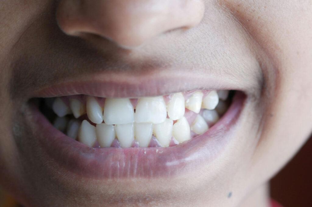 teeth grinding complications tooth wear close up