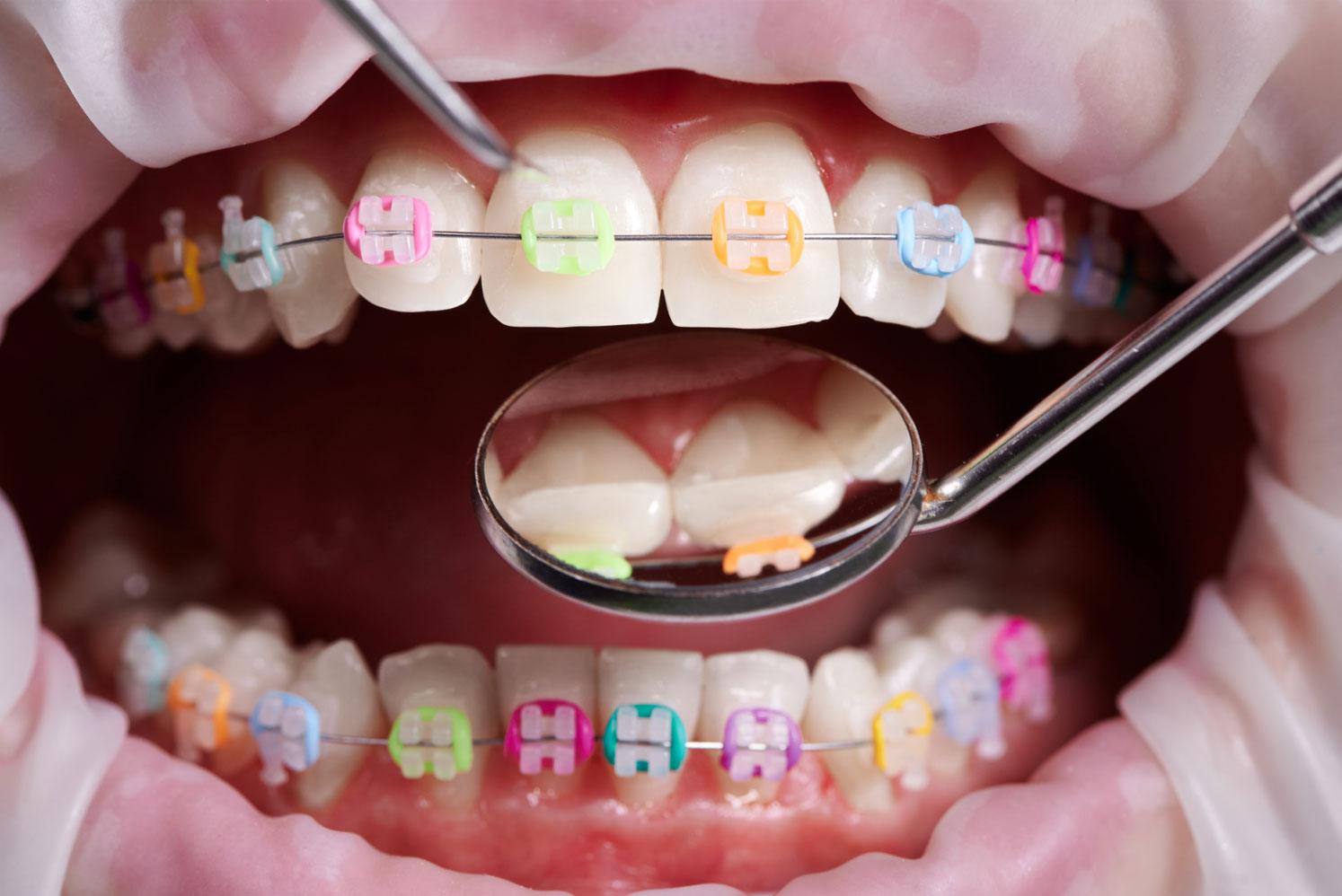 braces kid-friendly soft ideas