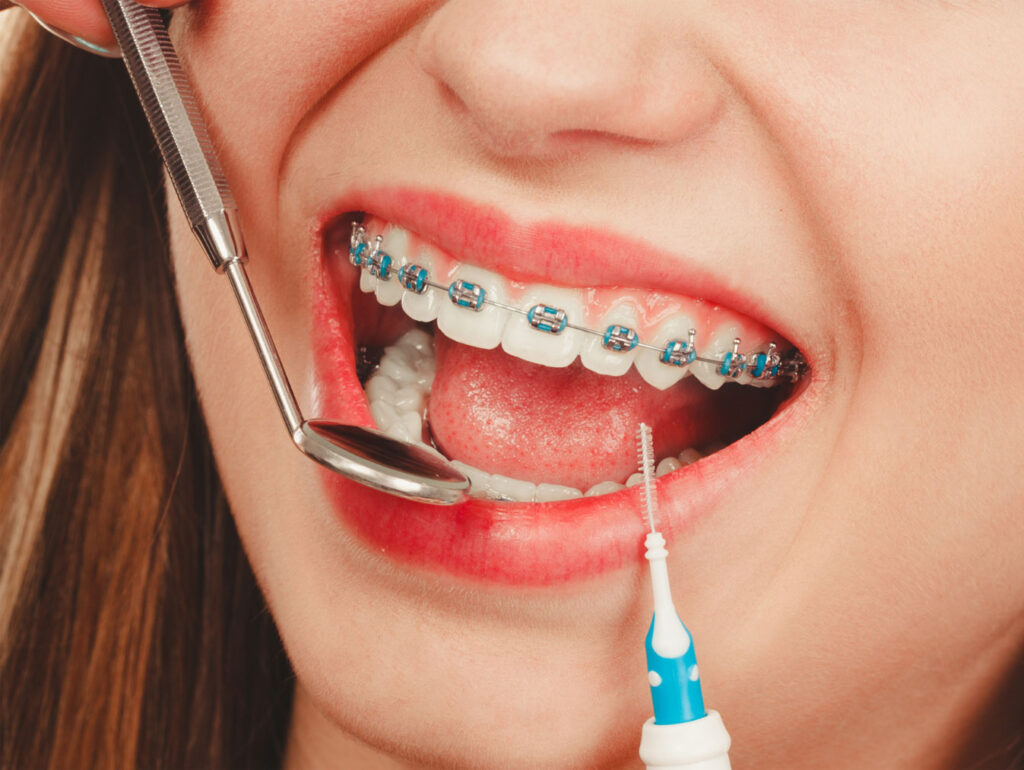

brushing at 45 degree angle around brackets oral hygiene with braces

