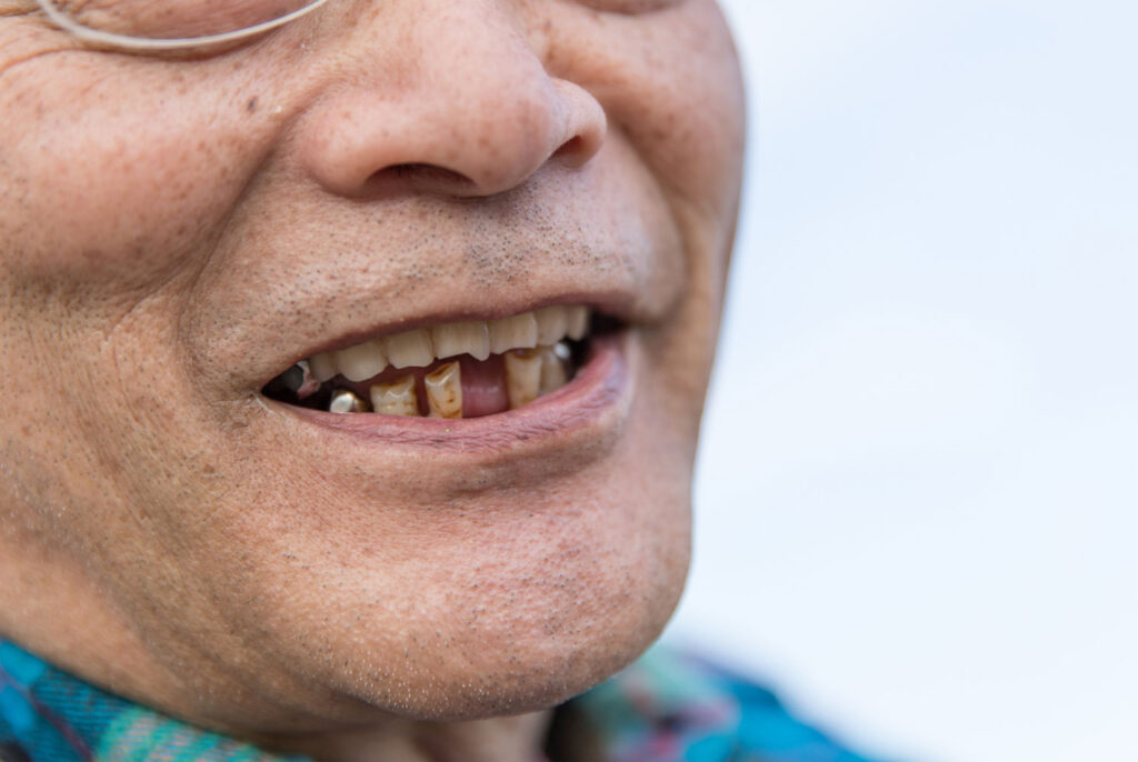 missing teeth problems difficulty chewing and nutrition changes