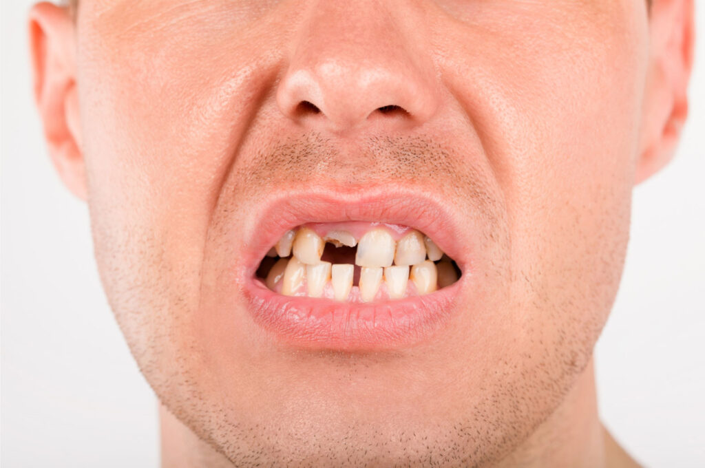 missing tooth gap causing shifting teeth and bite changes