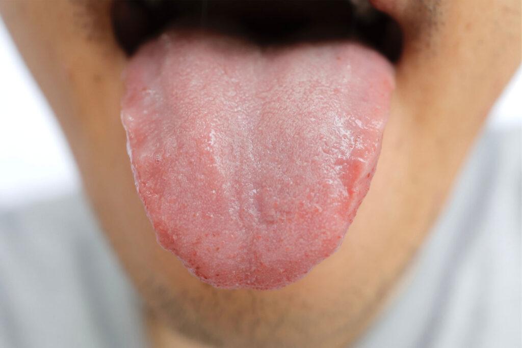 dry mouth and bad breath causes dehydration medication