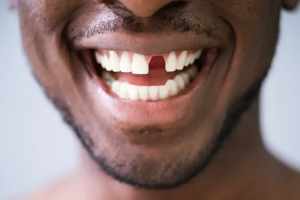 How Missing Teeth Can Lead to Problems