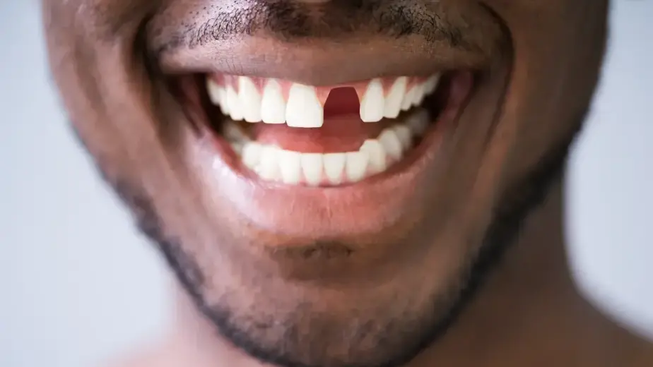 How Missing Teeth Can Lead to Problems