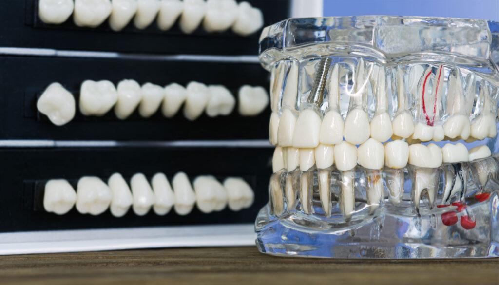 root canal treatment to save a natural tooth illustration