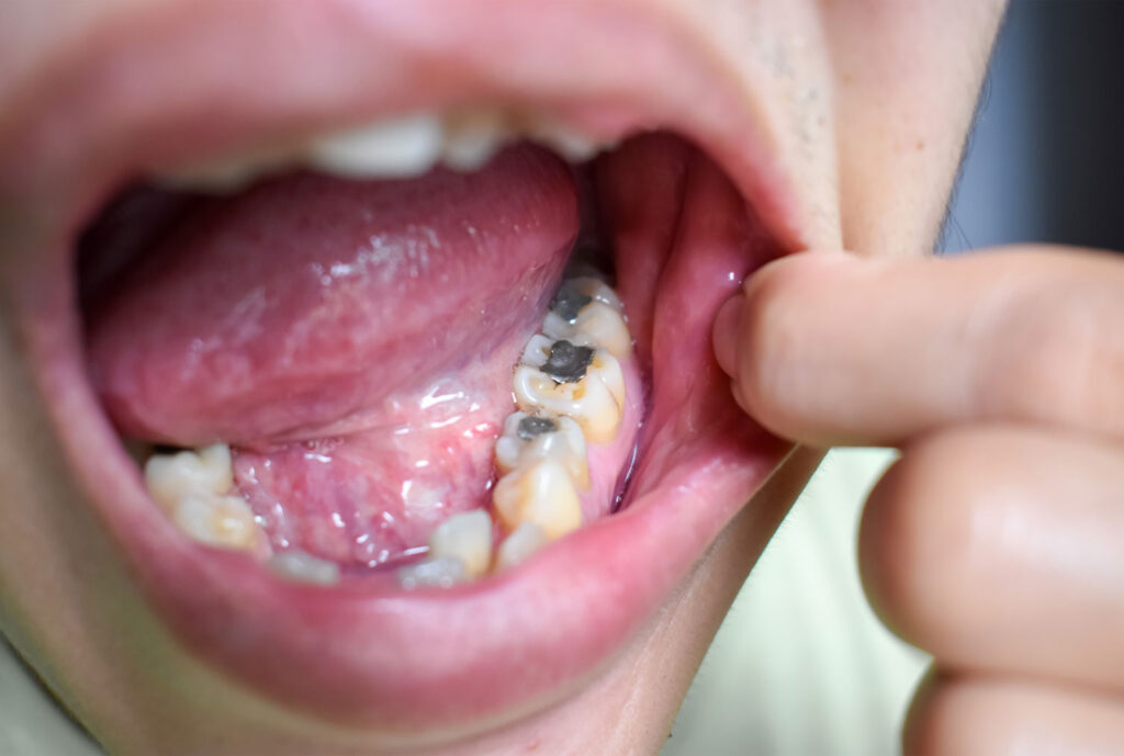 amalgam filling on molar durability for back teeth