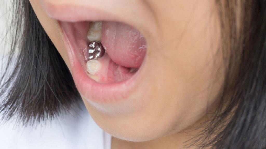 Amalgam-Fillings
