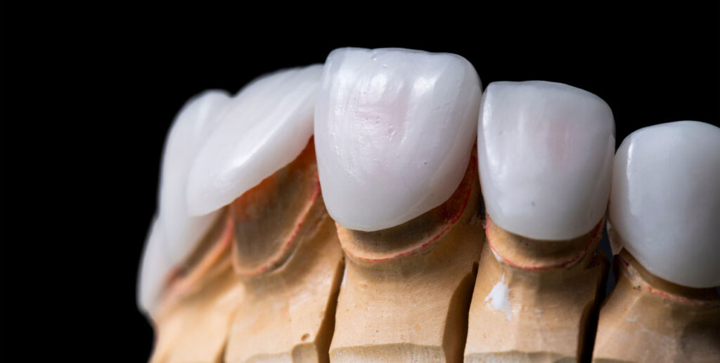 dental veneers improving shape color and spacing of teeth
