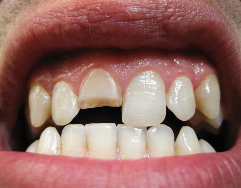 cracked tooth syndrome pain when biting chewing symptom