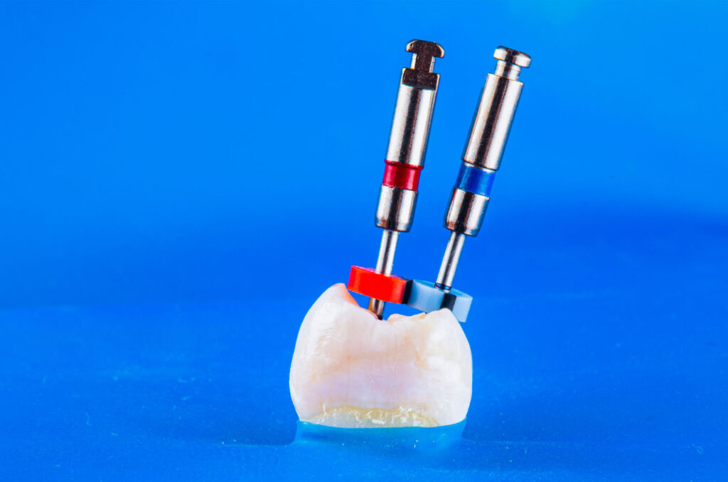 saving natural tooth with root canal treatment