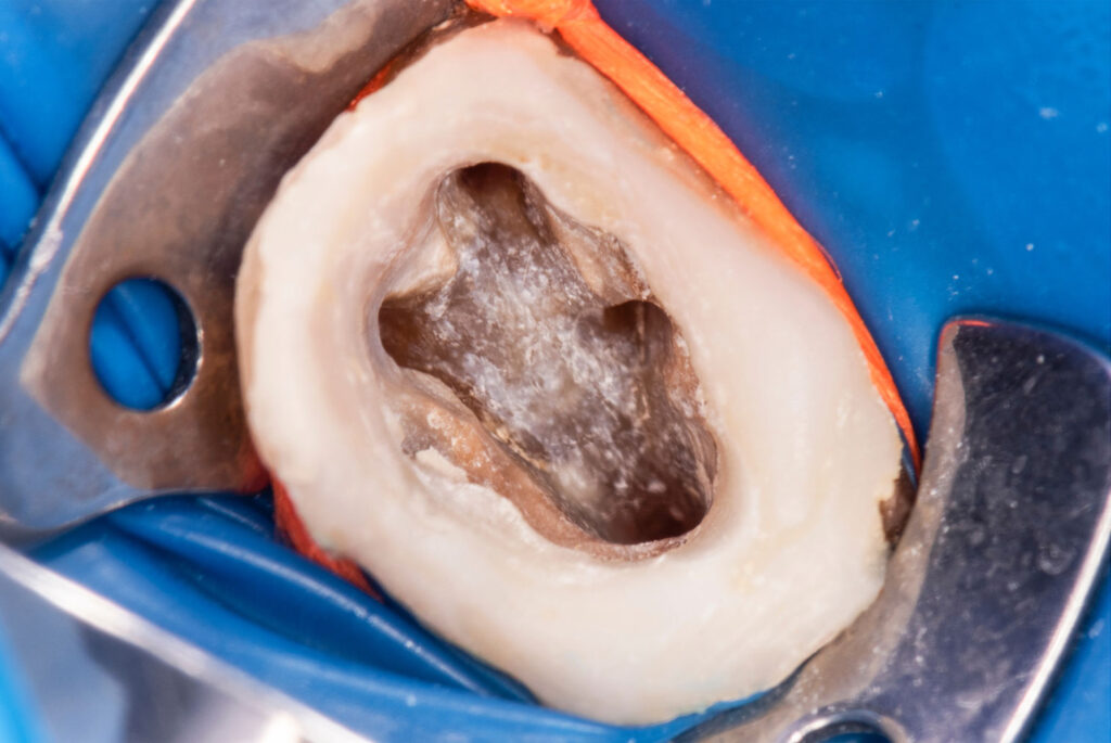 infected tooth symptoms swelling sensitivity abscess