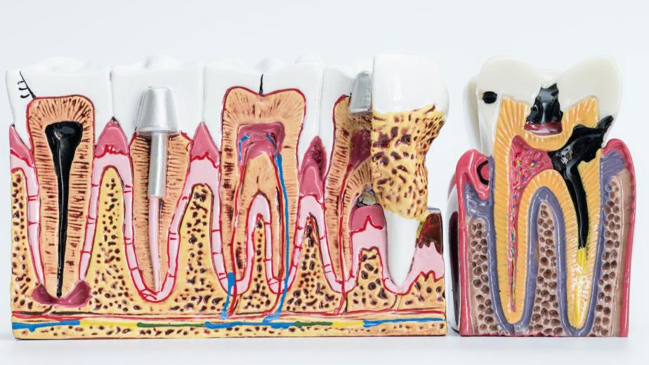 Types of Cracked tooth in Carlsbad
