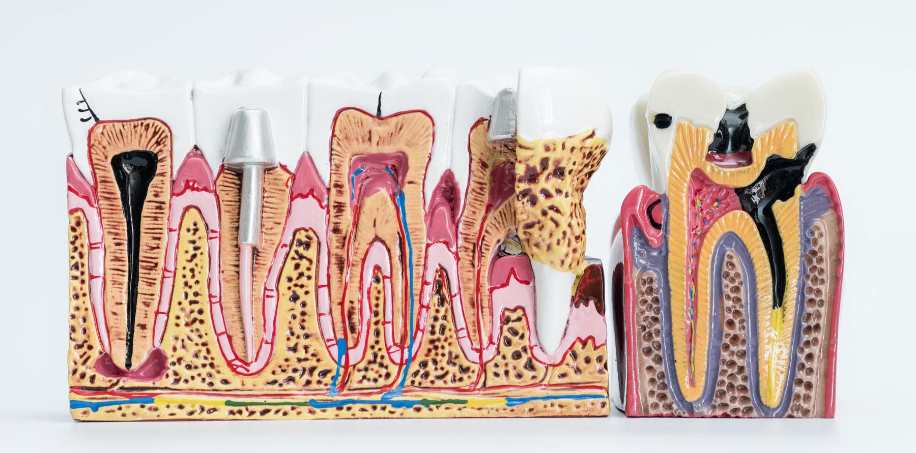 Types of Cracked tooth in Carlsbad