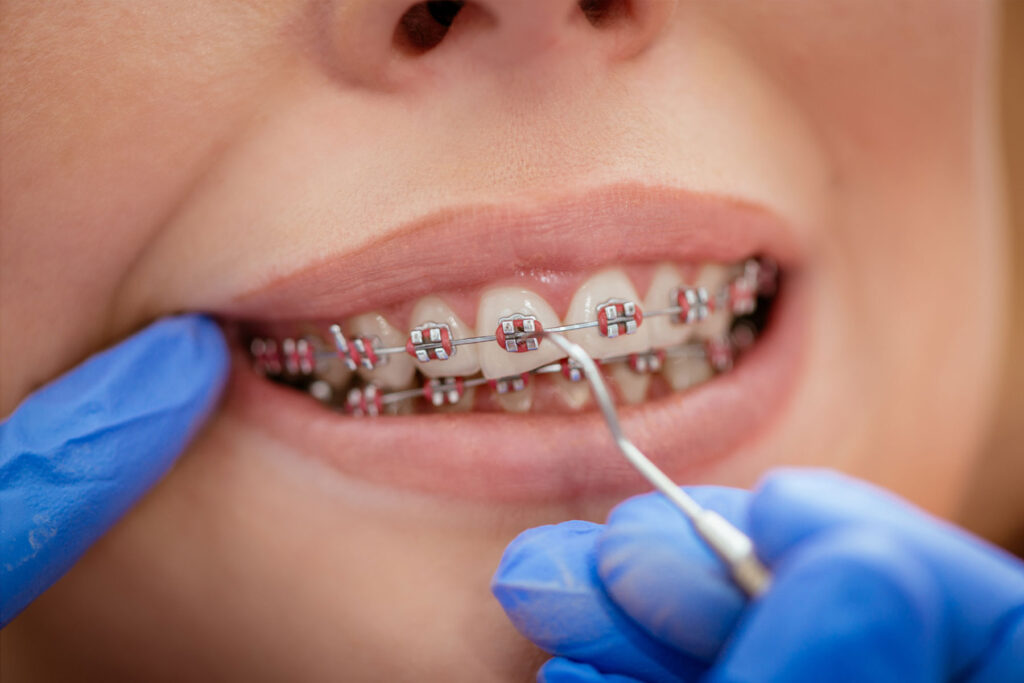 close-up of braces brackets and wire on teeth during orthodontic care