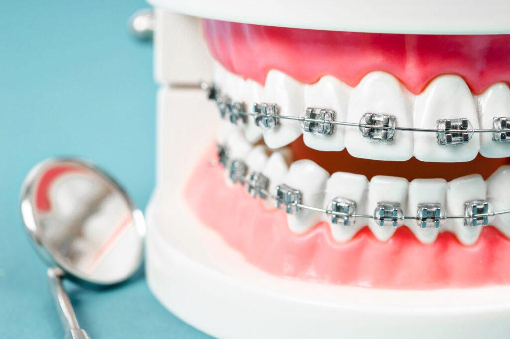orthodontic braces brackets on teeth