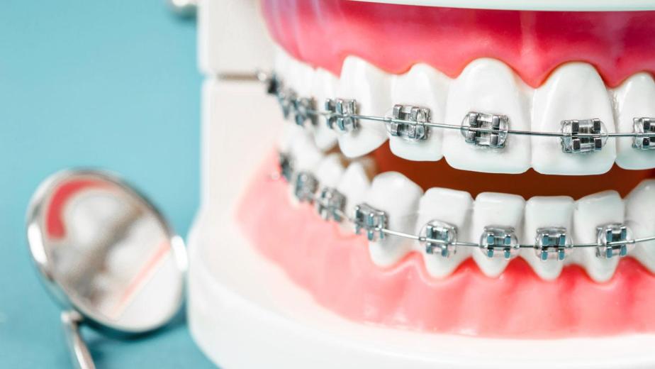 orthodontic braces brackets on teeth