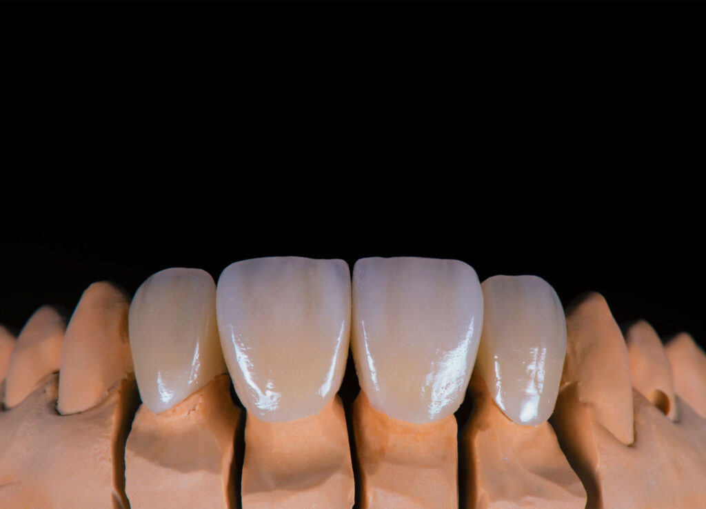 dental crowns in Carlsbad porcelain crown matching natural tooth shade