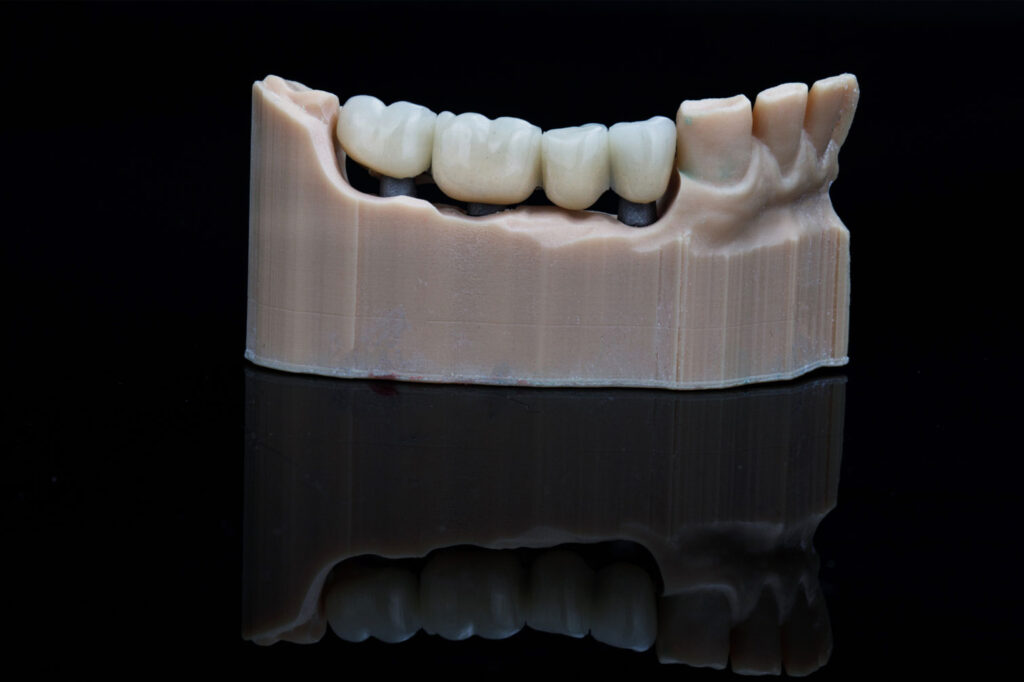 dental crown restoration close-up of a molar with crown placement