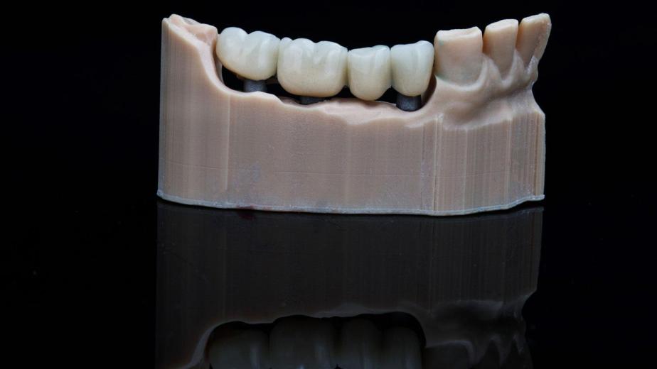 dental crown restoration close-up of a molar with crown placement