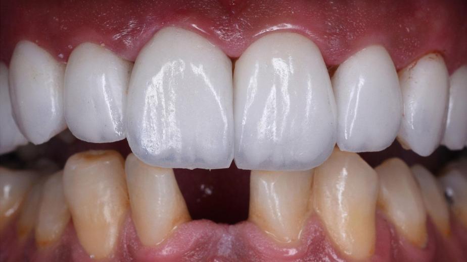Porcelain veneers on front teeth for a natural-looking smile