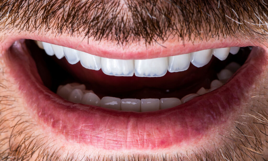 Patient smiling after veneer placement with brighter, even teeth