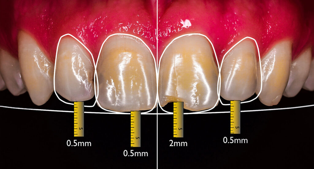 Cosmetic dentistry consultation discussing veneers treatment options