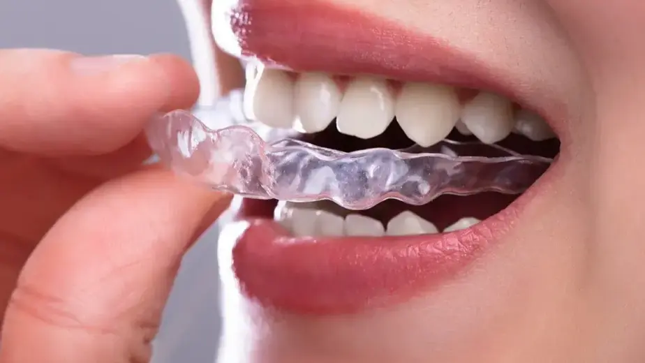 How Invisalign Aligners Work