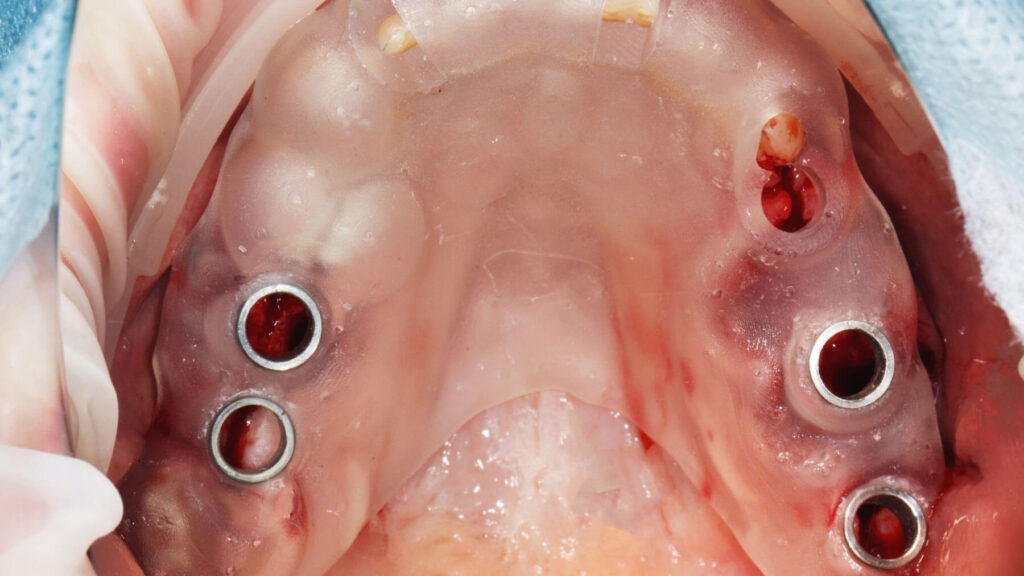 Full dentures used to replace all missing teeth in an arch