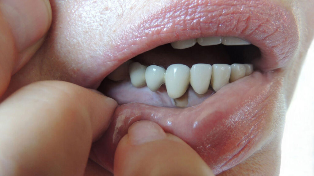 Receding gums exposing tooth roots linked to gum disease and sensitivity