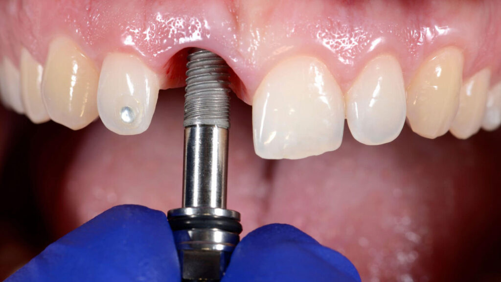 Dental implant crown restoration replacing a missing tooth naturally