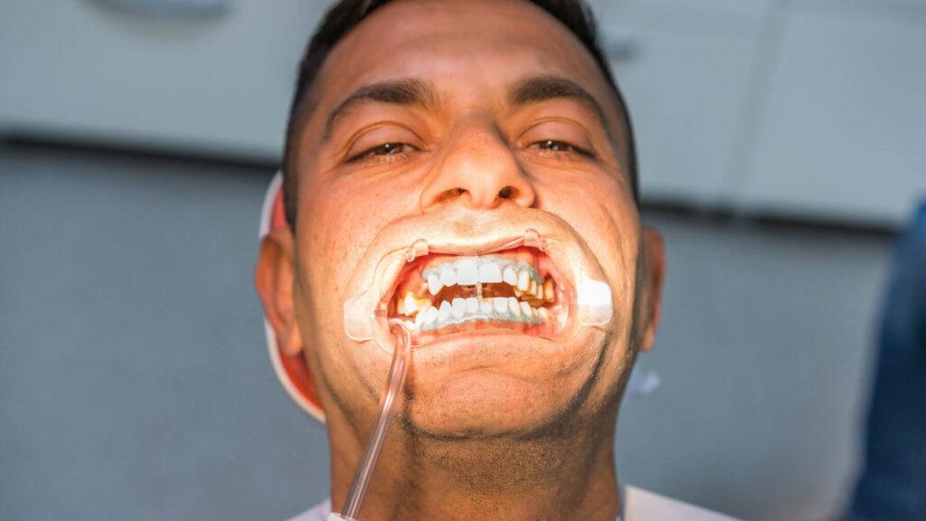 Procedure-for-Teeth-Whitening-in-Carlsbad-Smiles-For-Health
