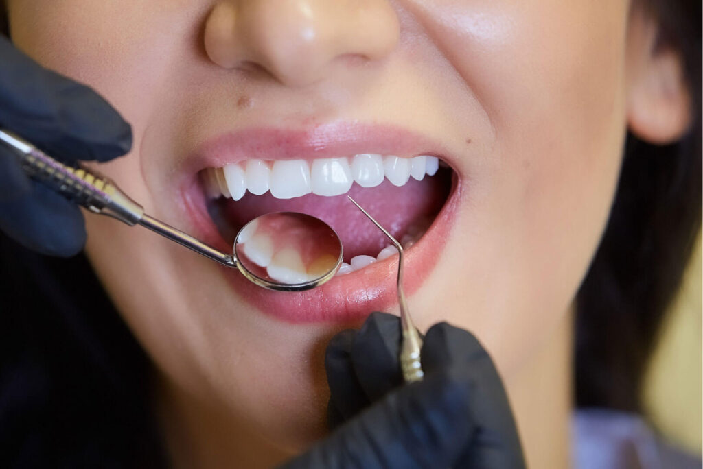 Receding gums exposing tooth roots that feel sensitive to cold