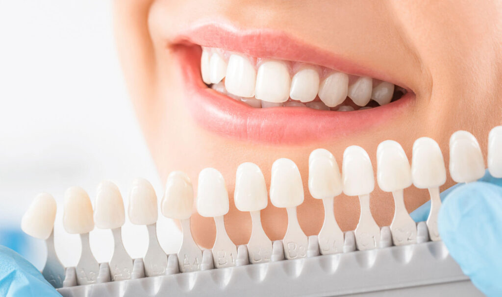 Person smiling with teeth whitening scale