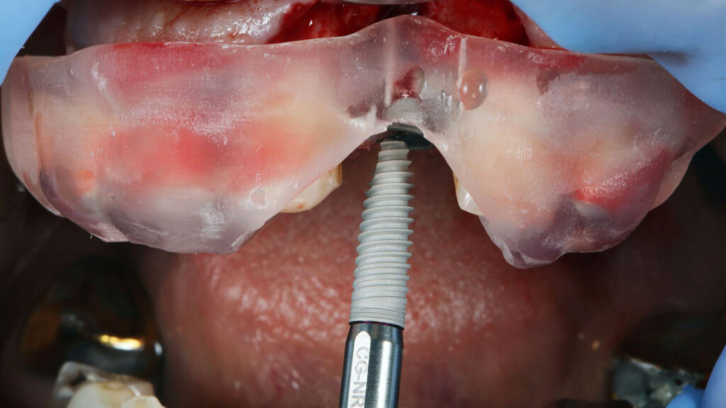 Surgery For Tooth Replacement Smiles For Health in Carlsbad