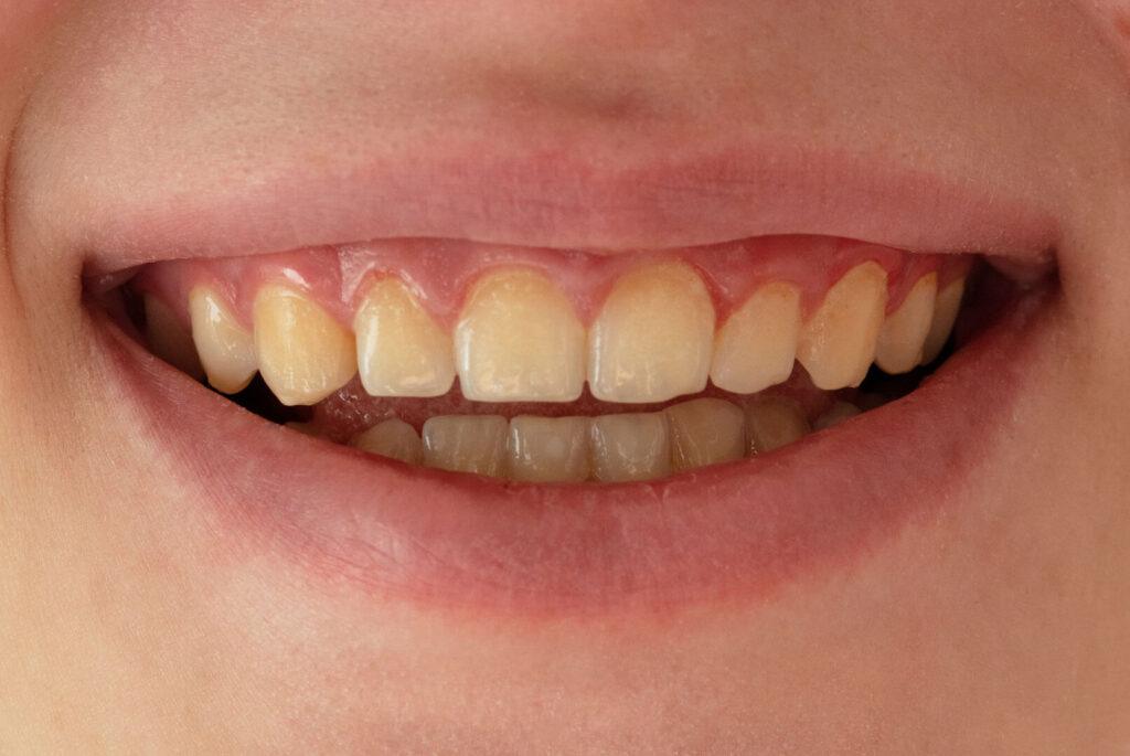 Close-up of teeth showing surface stains from coffee and red wine