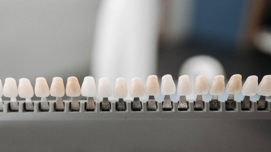 Types-of-Dental-Veneers