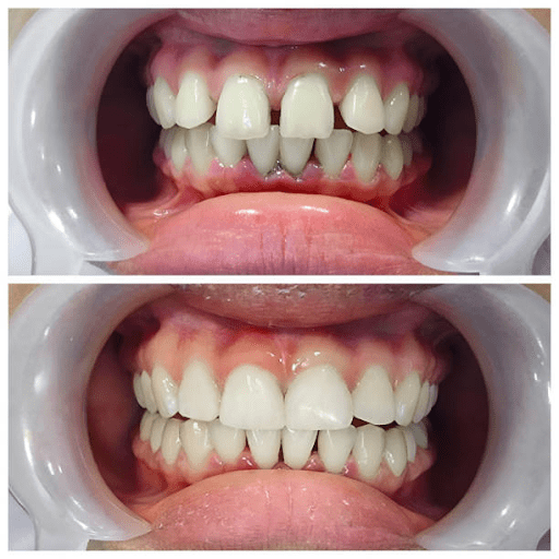 After And Before with Aligners