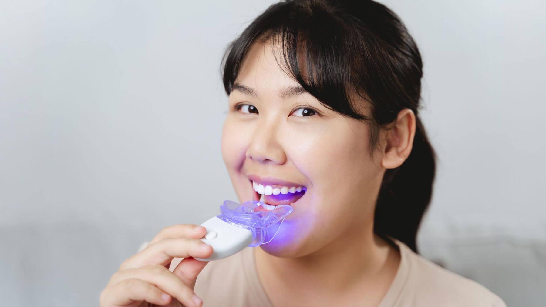 At Home Whitening with Mouthguard