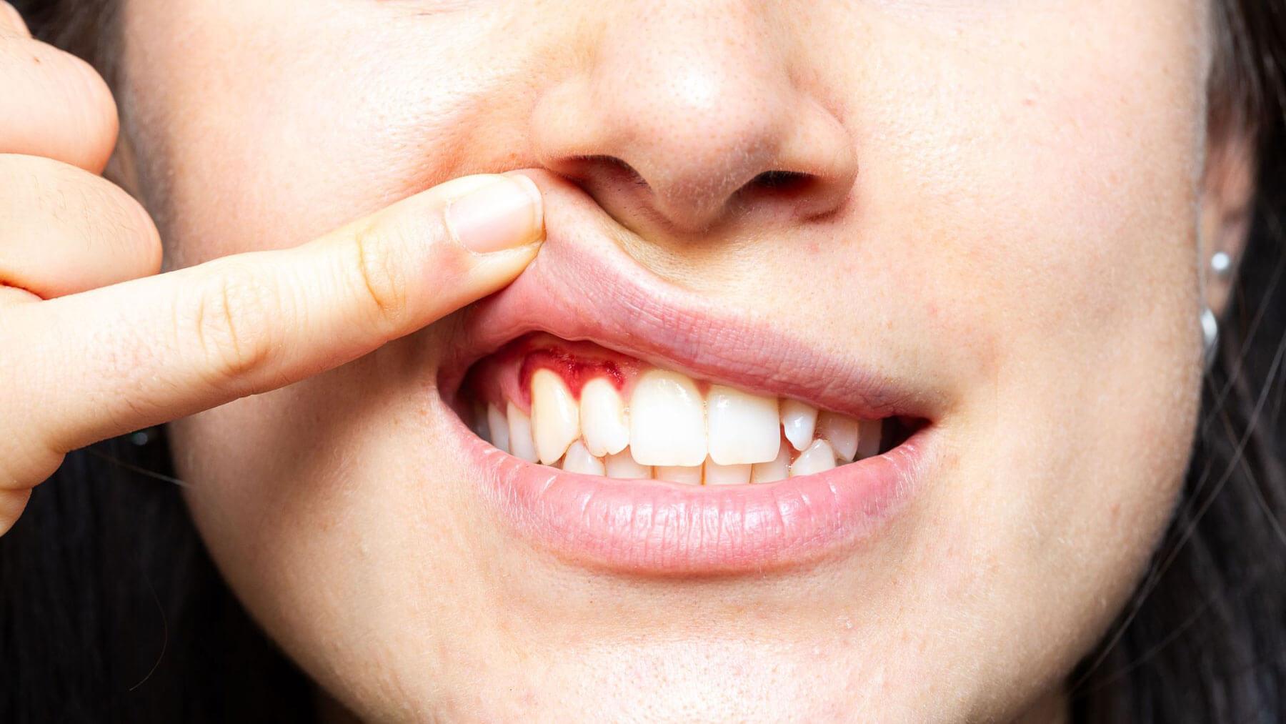 Blending Gum Disease