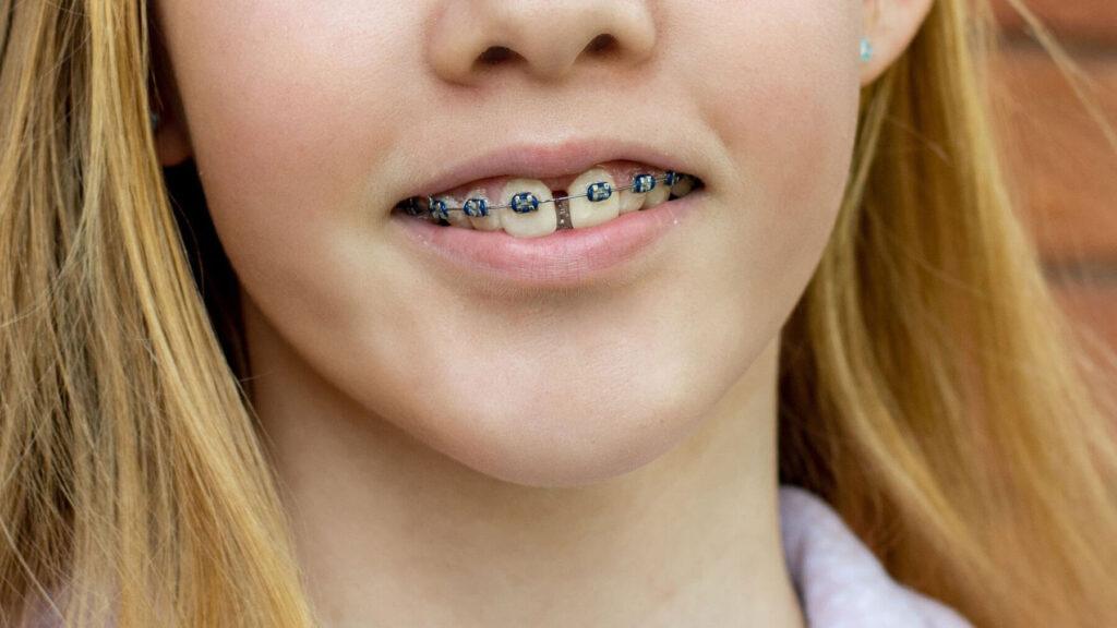 Braces For Gaps
