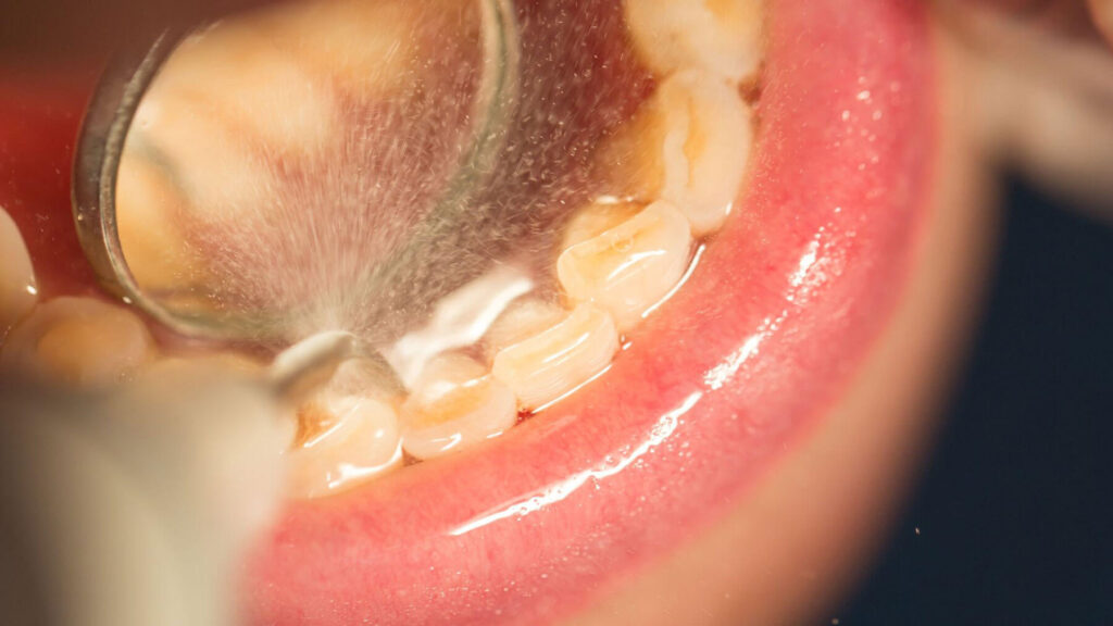 Cleaning Tartar Teeth